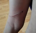 Бездомная собака в Холмске прокусила ногу 9-летнему мальчику